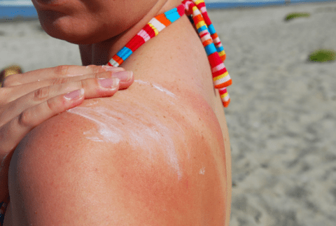 someone putting cream on their sunburn