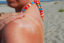 someone putting cream on their sunburn